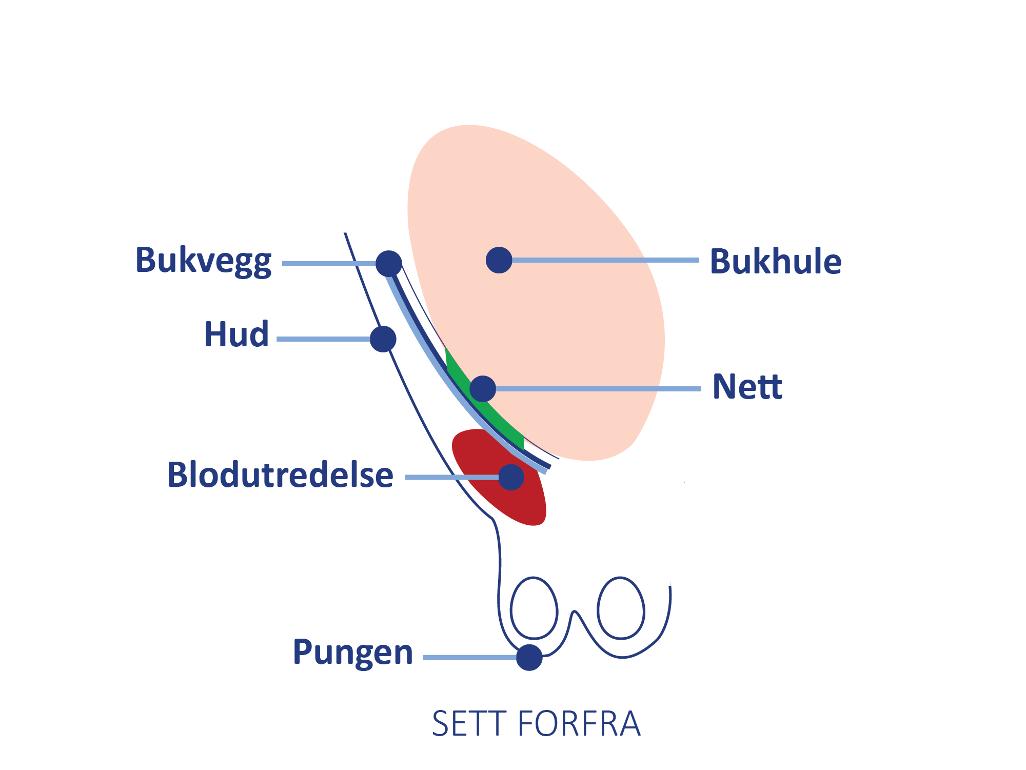 Anatomisk illustrasjon sett forfra som viser bukvegg, nett og en blodansamling (bloduttredelse) som kan oppstå etter operasjon.