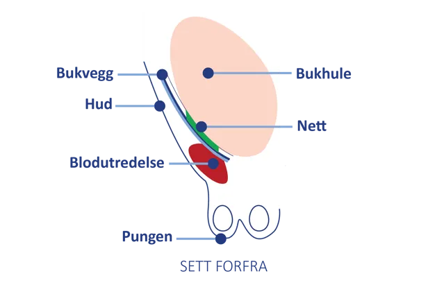 Anatomisk illustrasjon sett forfra som viser bukvegg, nett og en blodansamling (bloduttredelse) som kan oppstå etter operasjon.
