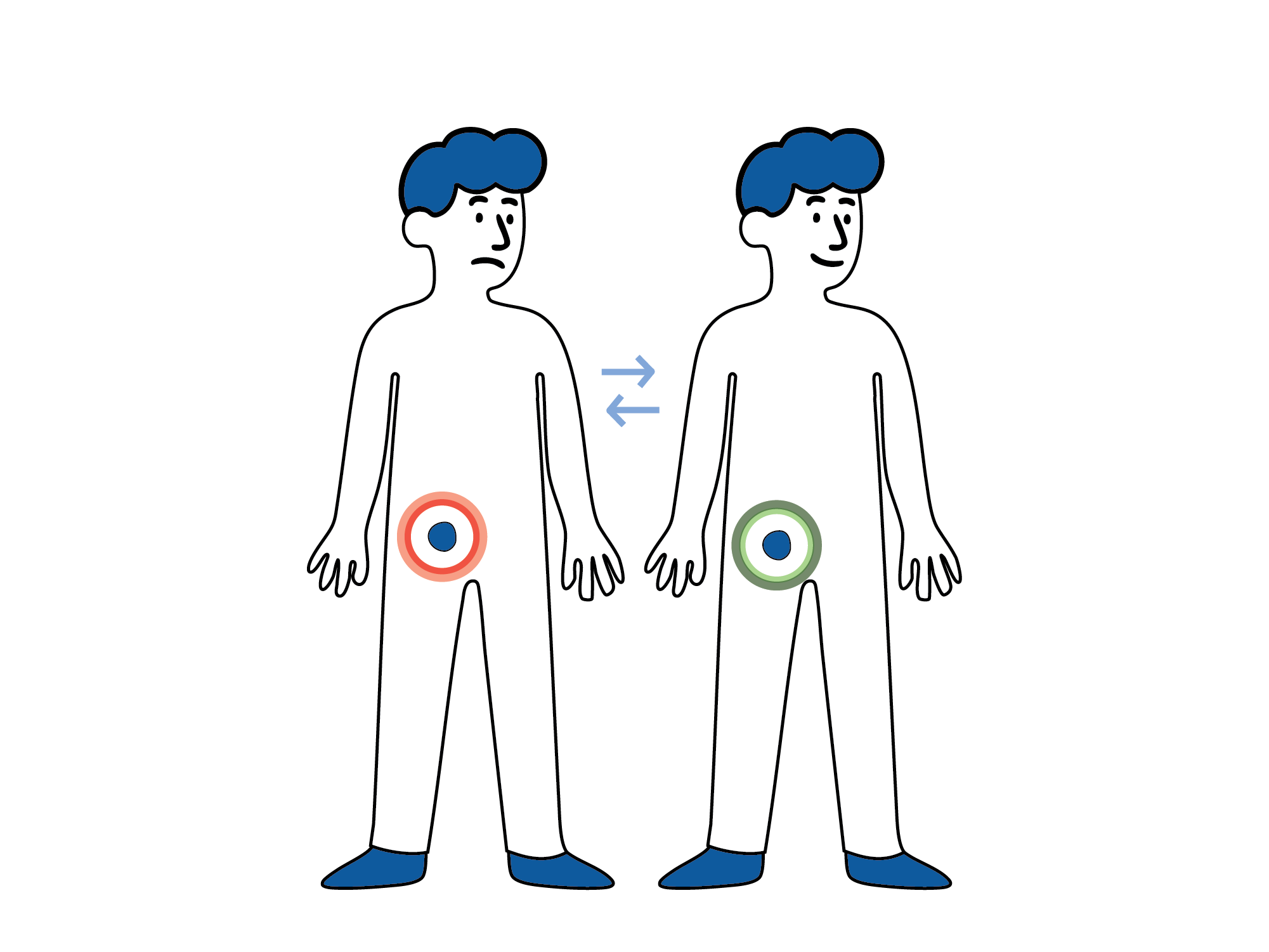 Medisinsk illustrasjon som viser at en lyskebrokk kan komme og gå, med vev som midlertidig buler ut i lysken.