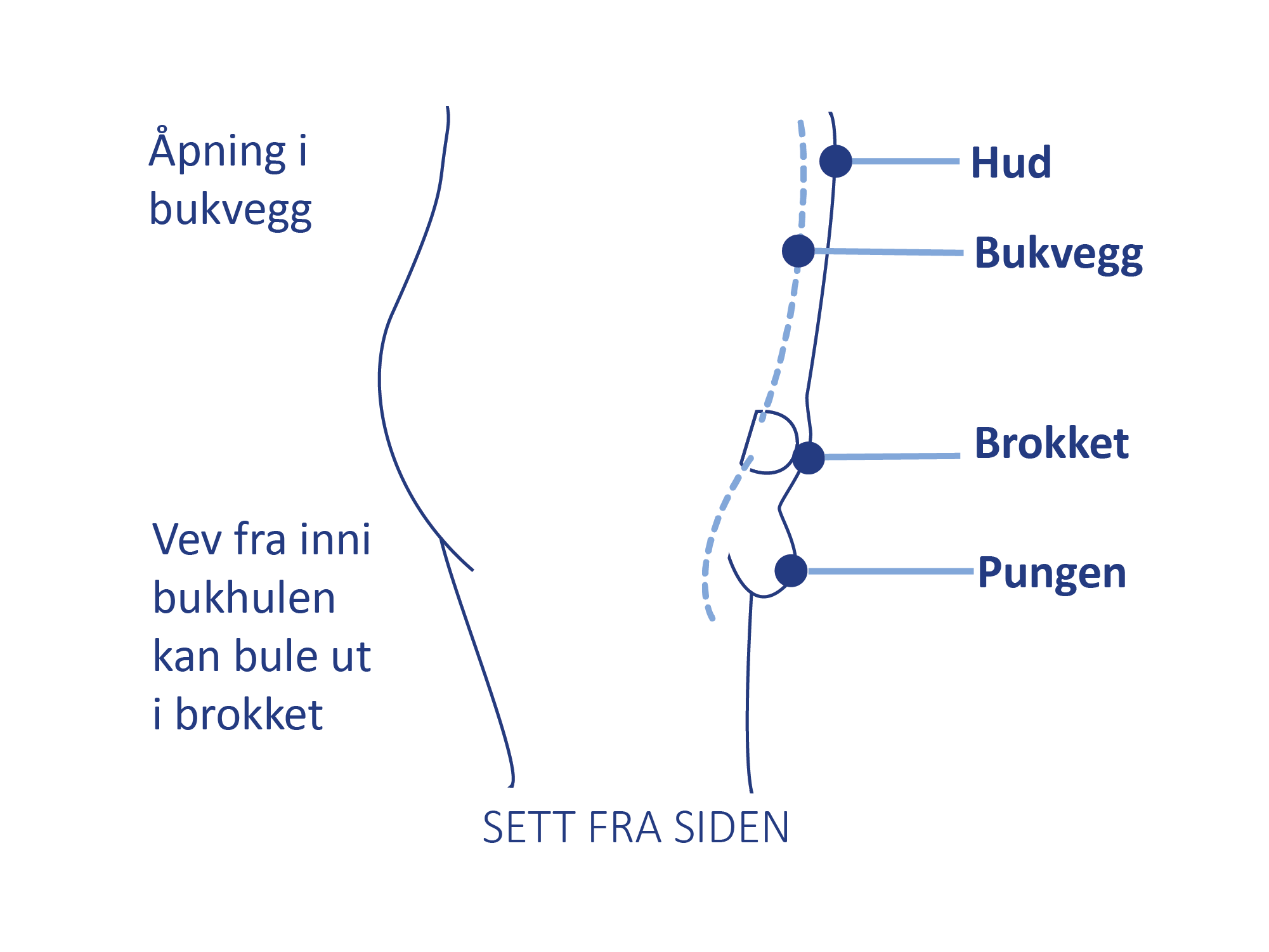 Medisinsk illustrasjon som viser vev fra bukhulen som presser seg ut gjennom et brokk