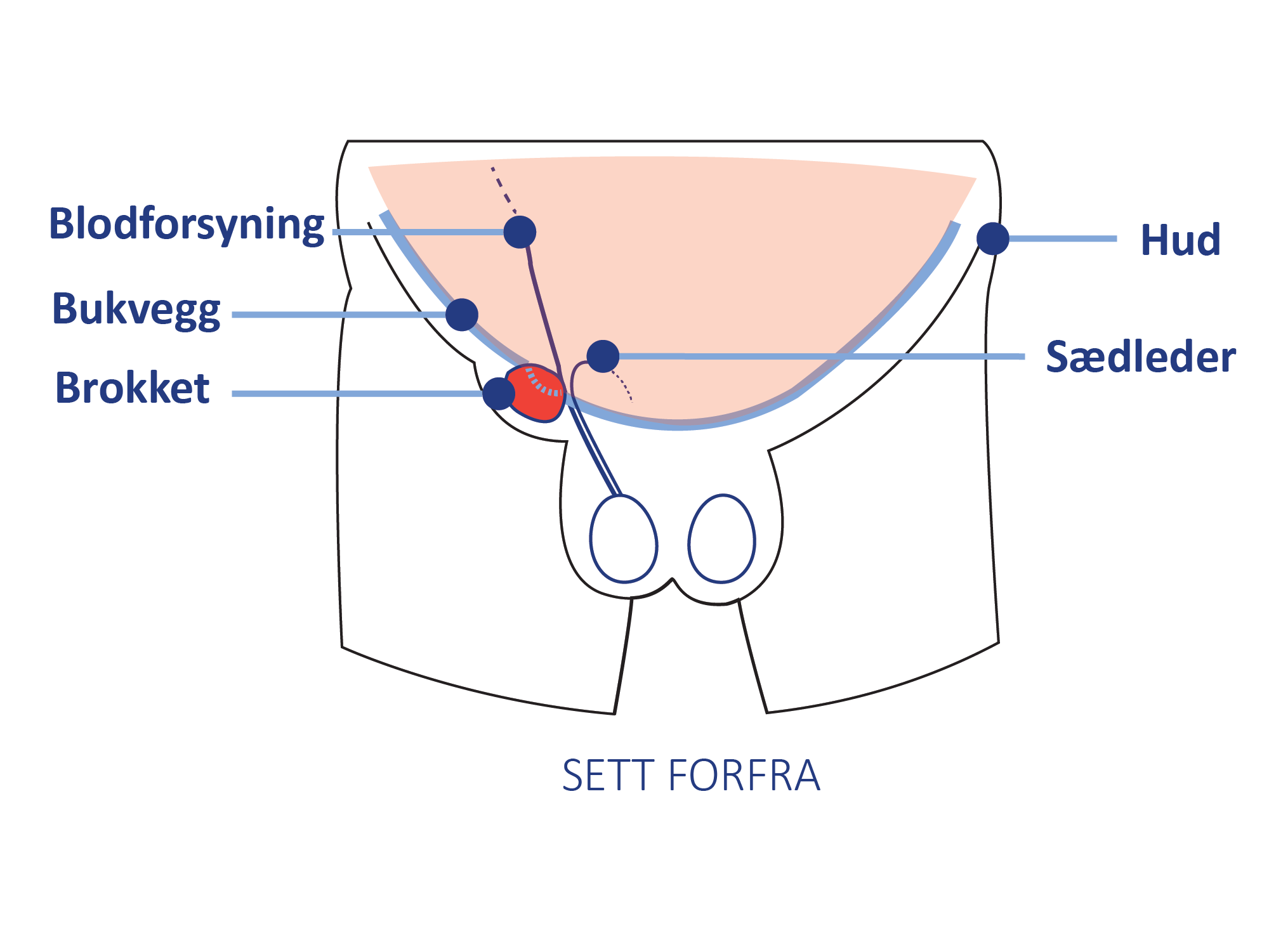 Anatomisk illustrasjon av lyskeområdet sett forfra, med markering av bukvegg, blodforsyning, sædleder og hud.