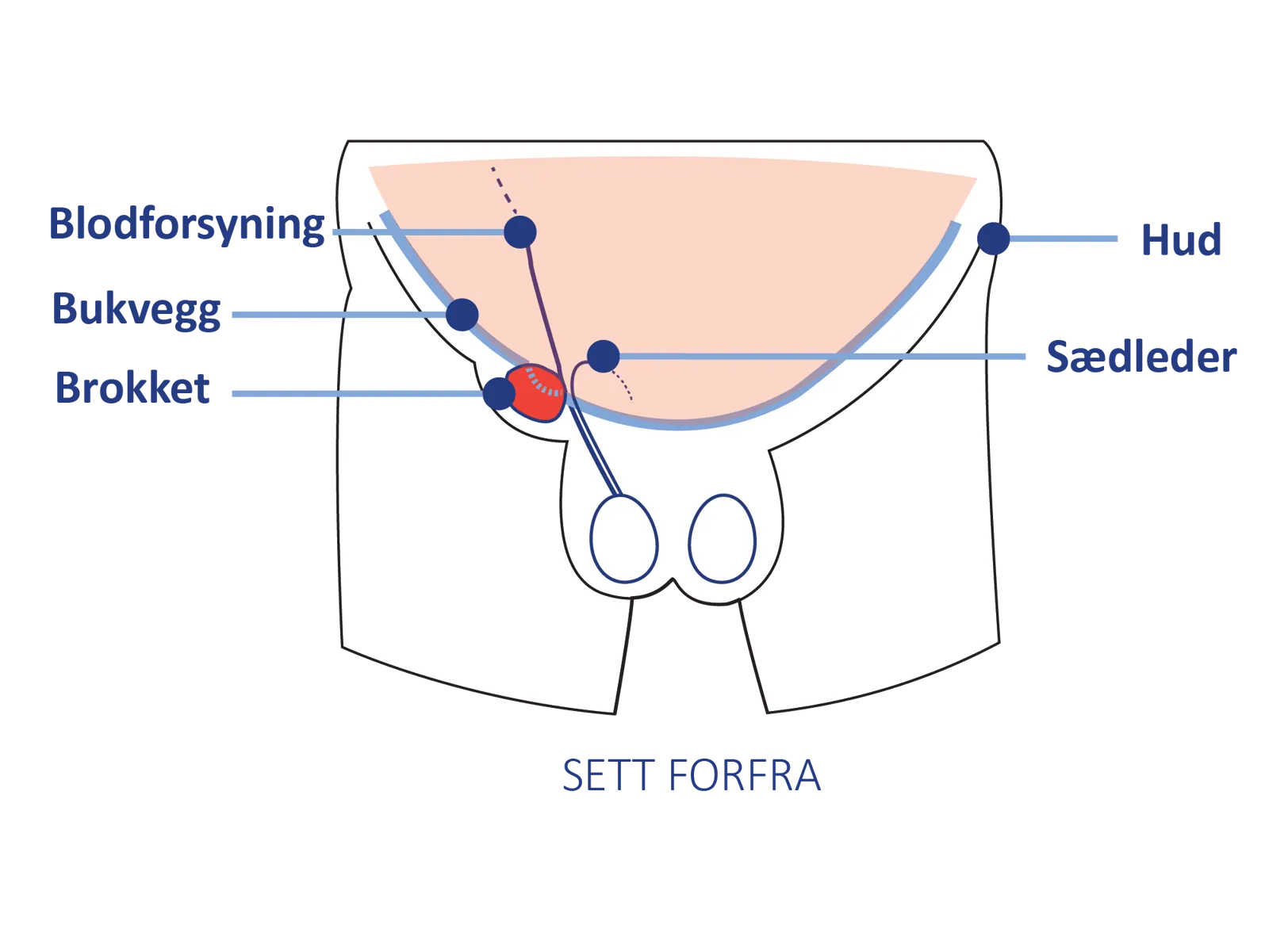 Anatomisk illustrasjon av lyskeområdet sett forfra, med markering av bukvegg, blodforsyning, sædleder og hud.