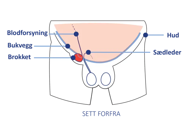 Anatomisk illustrasjon av lyskeområdet sett forfra, med markering av bukvegg, blodforsyning, sædleder og hud.