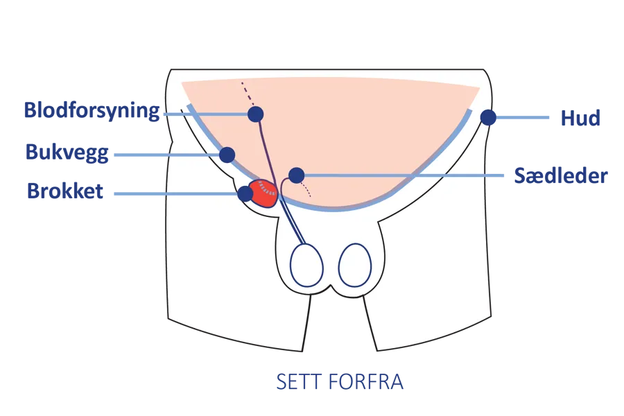 Anatomisk illustrasjon av lyskeområdet sett forfra, med markering av bukvegg, blodforsyning, sædleder og hud.