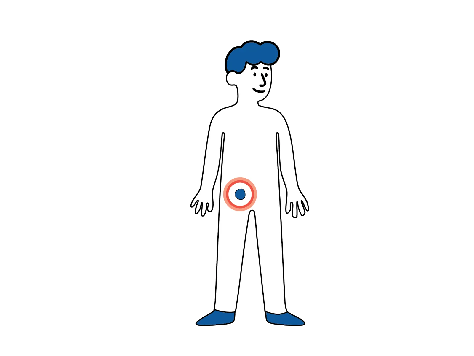 llustrasjon av en person sett forfra med en markering i lysken som viser området der lyskebrokk kan oppstå