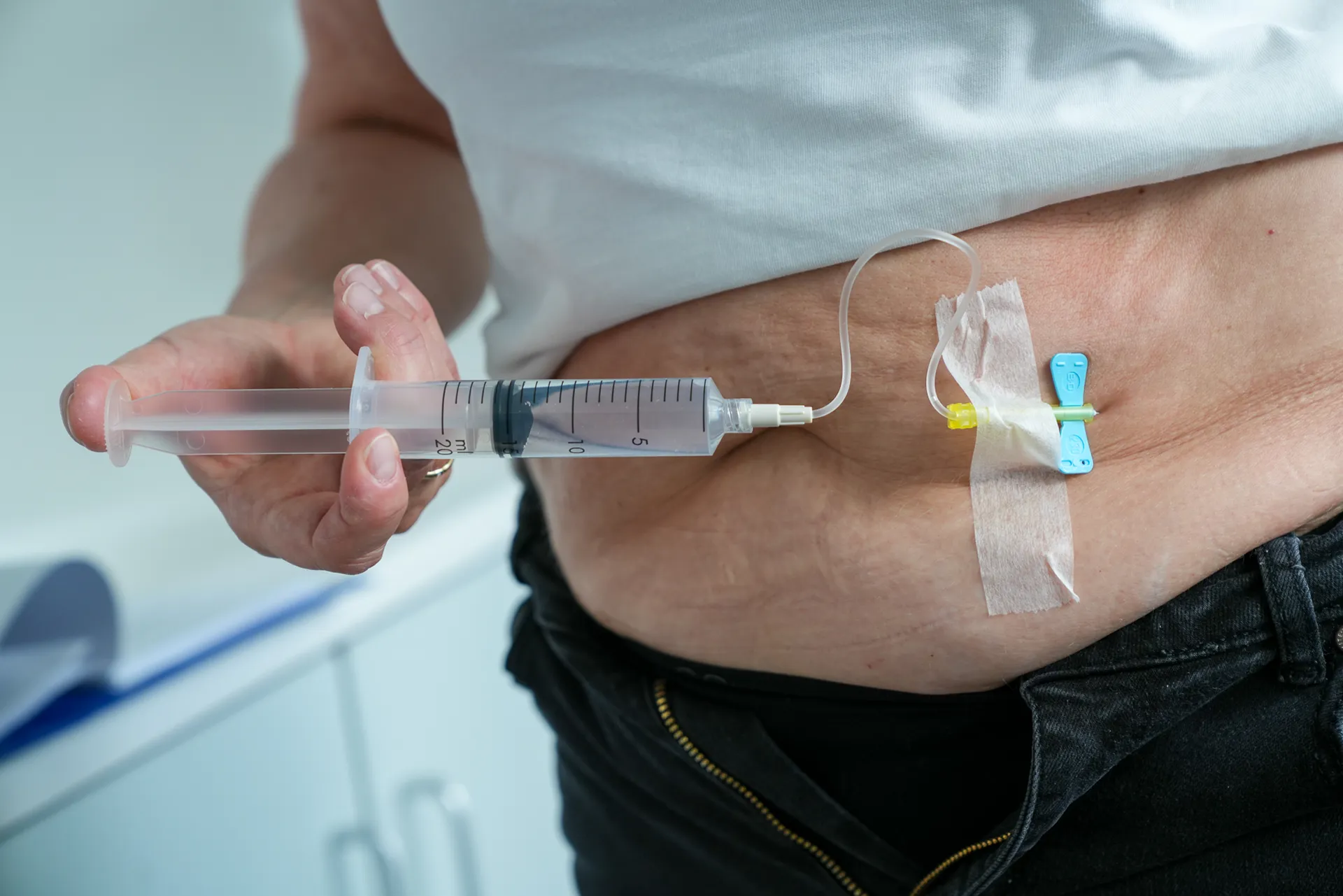 Hånd som holder en sprøyte koblet til en innstikknål festet til huden på magen. Slangen er teipet fast, og sprøyten brukes til å skylle eller administrere væske gjennom innstikket.