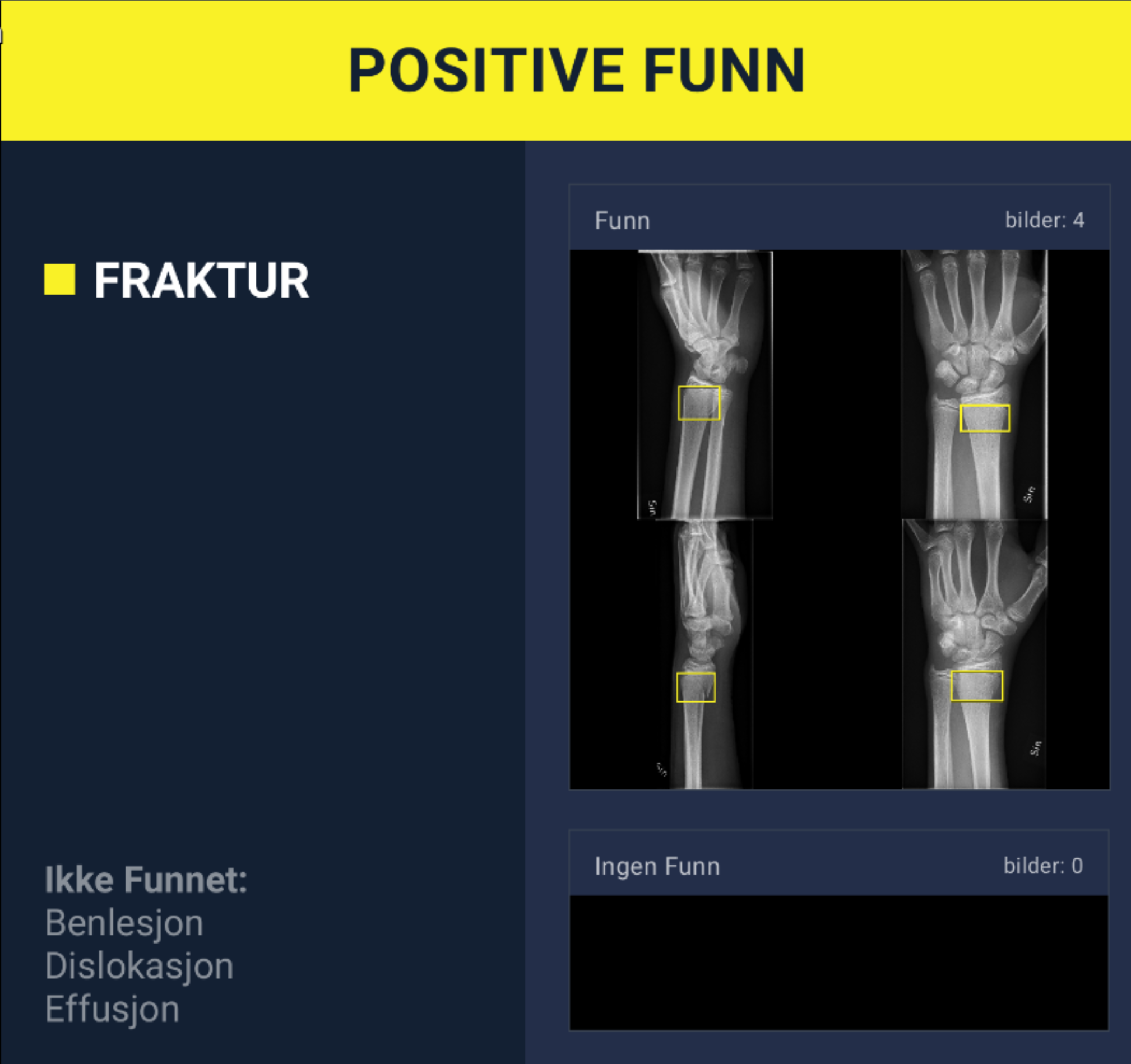 En medisinsk rapport viser fire røntgenbilder av en håndleddsskade. Et gult rektangel markerer et brudd i håndleddet på alle bildene. Rapporten oppgir ‘Fraktur’ som positivt funn, og lister ‘Benlesjon’, ‘Dislokasjon’ og ‘Effusjon’ som ikke funnet.