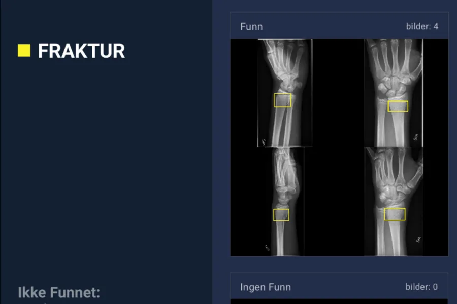 Røntgenbilder av håndledd med markert fraktur, vist i et medisinsk system med kategorien «Positive funn