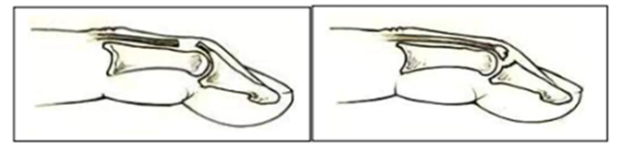Illustrasjon av dropfinger