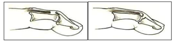 Illustrasjon av dropfinger