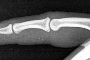Røntgenbilde av finger
