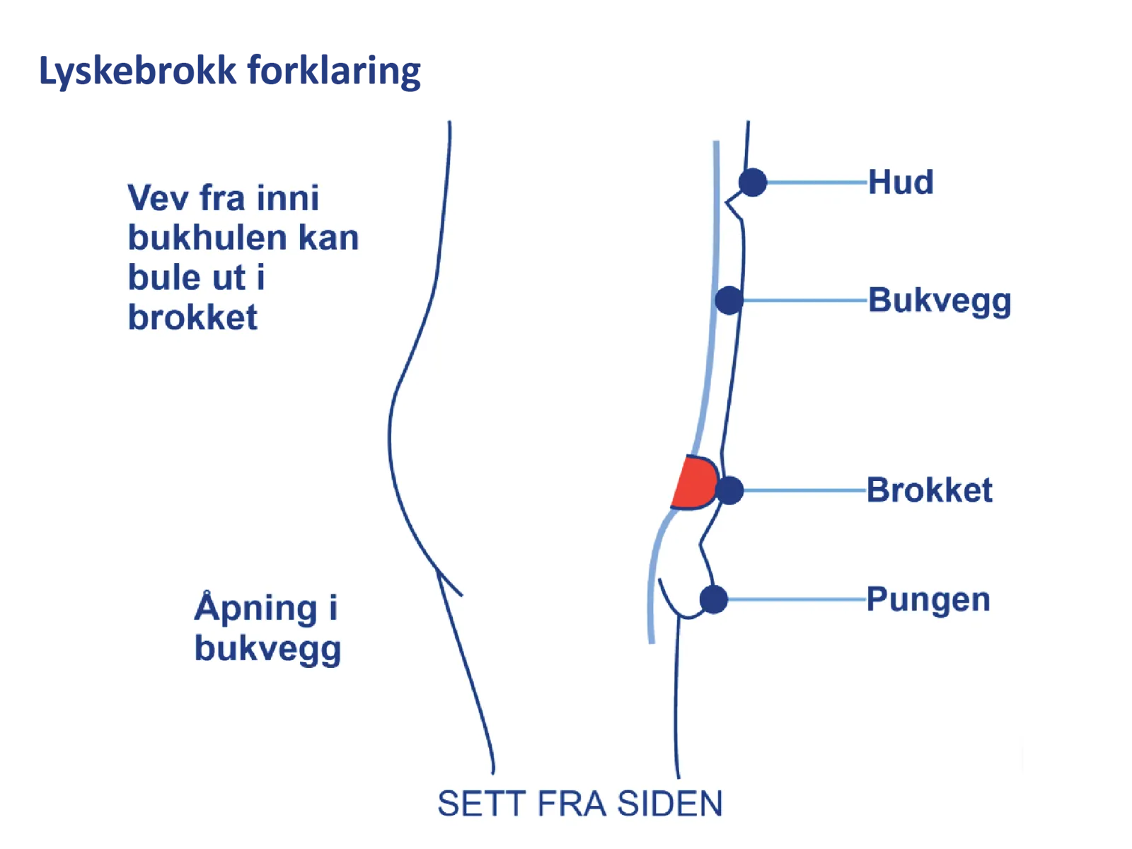 Medisinsk illustrasjon som viser vev fra bukhulen som presser seg ut gjennom et brokk