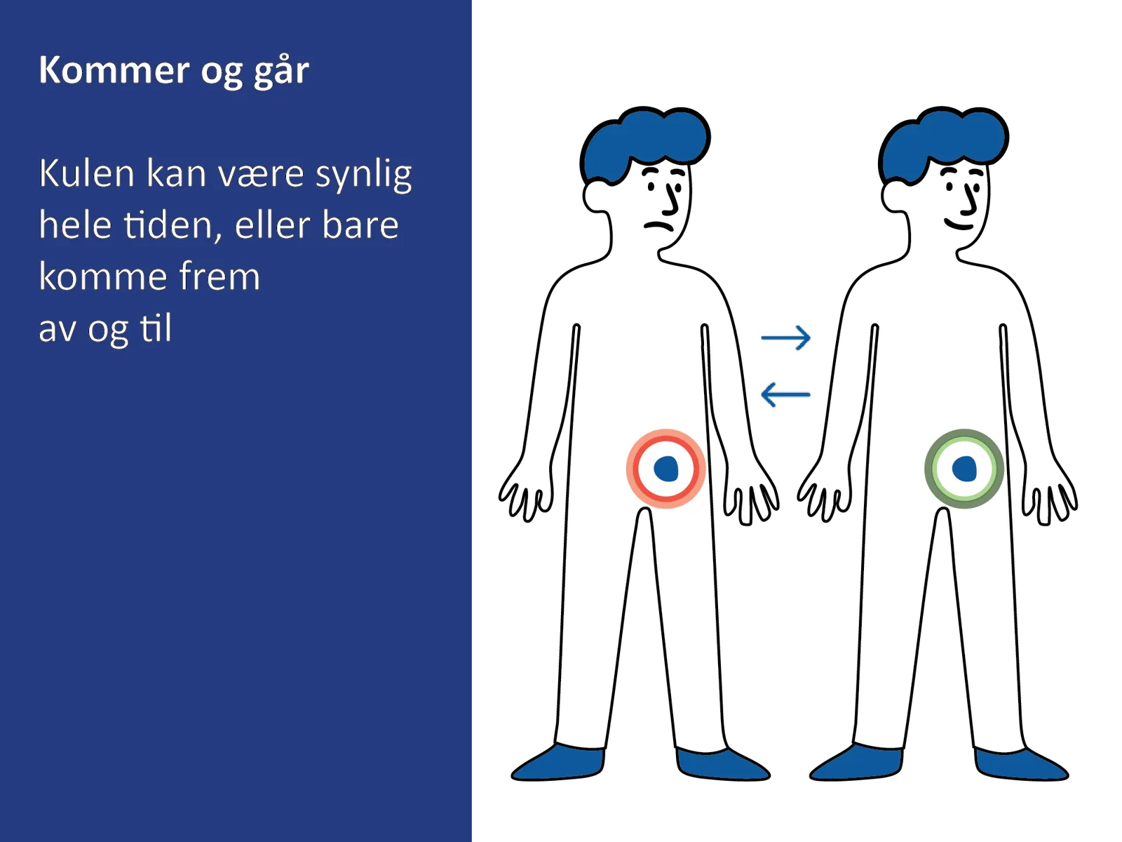 Medisinsk illustrasjon som viser at en lyskebrokk kan komme og gå, med vev som midlertidig buler ut i lysken.