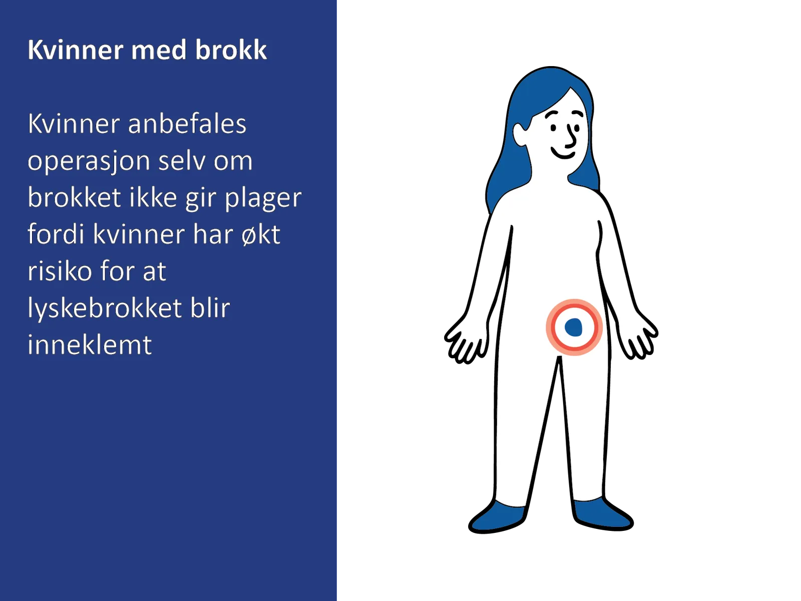 Medisinsk illustrasjon av en kvinne med lyskebrokk, der brokket vises som en kul i lysken.