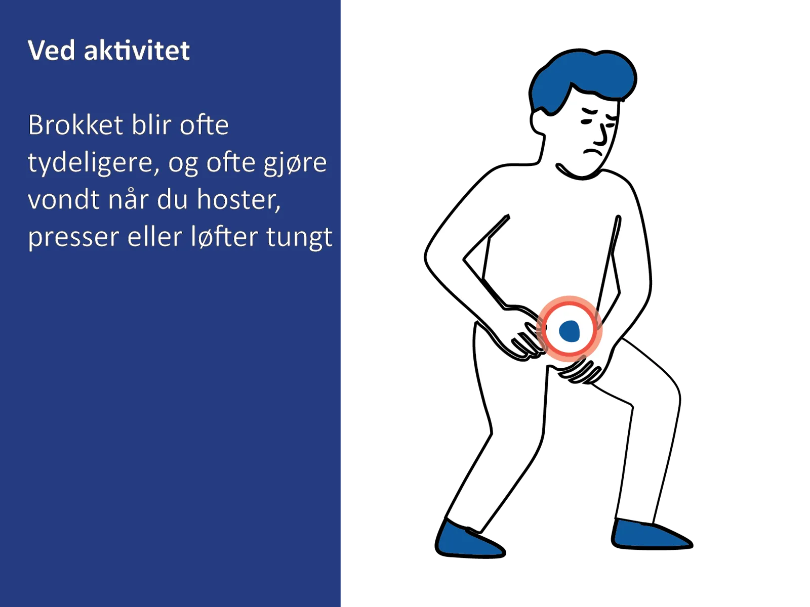 Medisinsk illustrasjon som viser at lyskebrokk gir smerter ved hosting, pressing eller tunge løft.