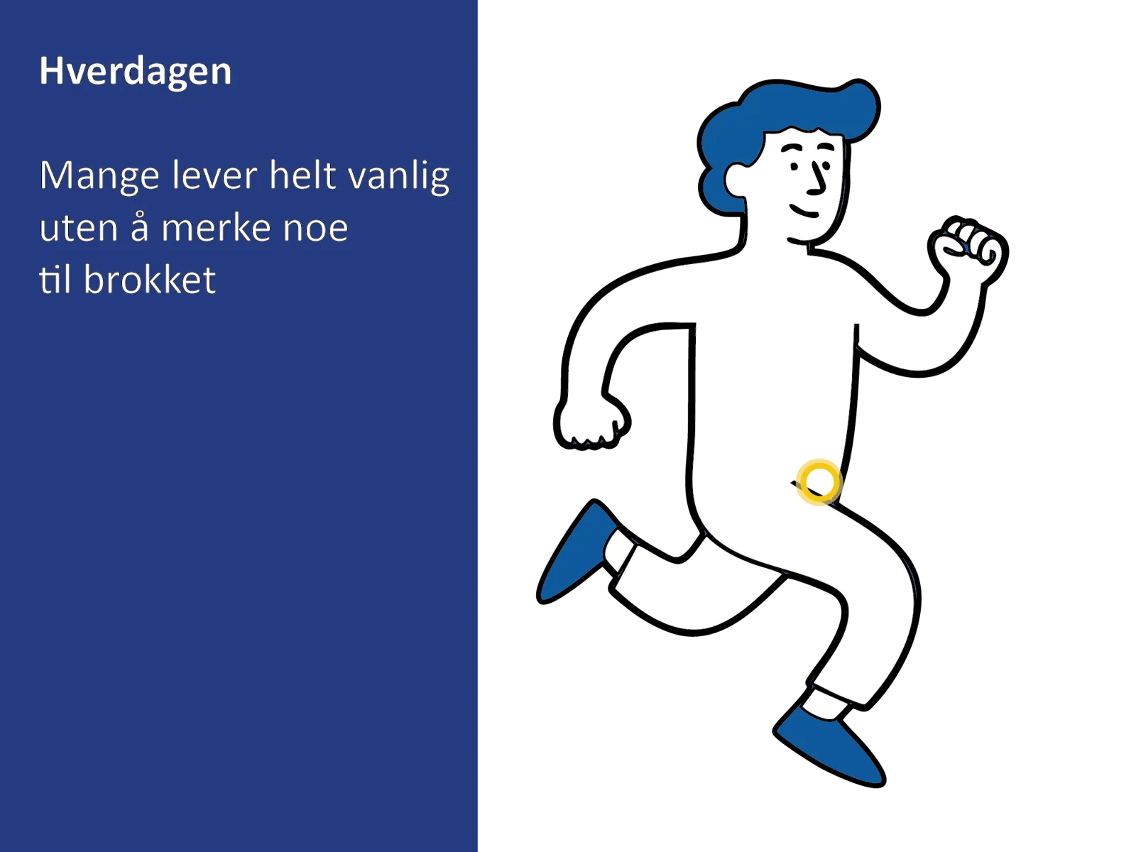 Medisinsk illustrasjon som viser at lyskebrokk kan være symptomfri og ikke merkes i hverdagen.