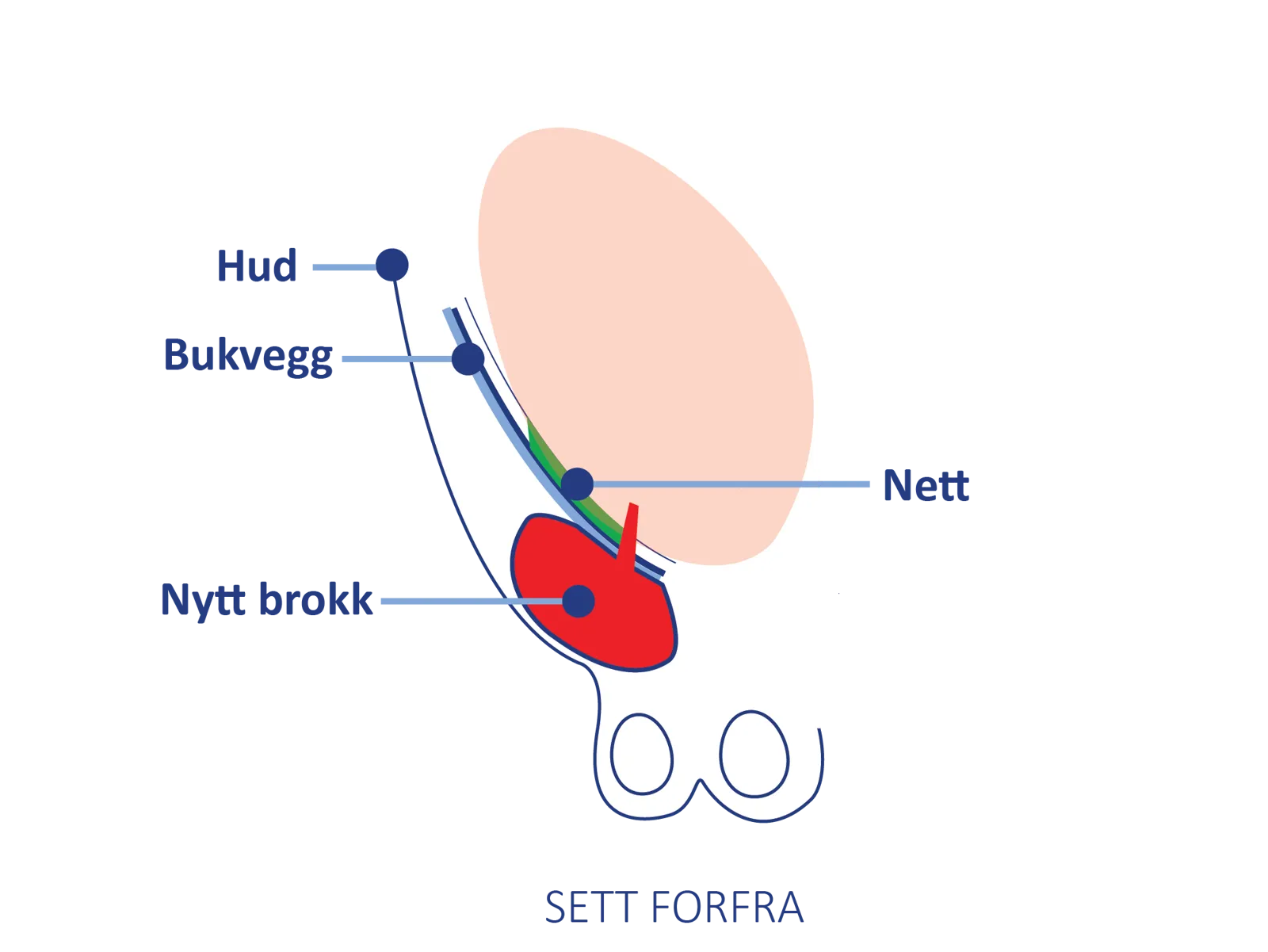 Anatomisk illustrasjon sett forfra som viser bukvegg, hud, nett og et nytt brokk som har oppstått ved lysken