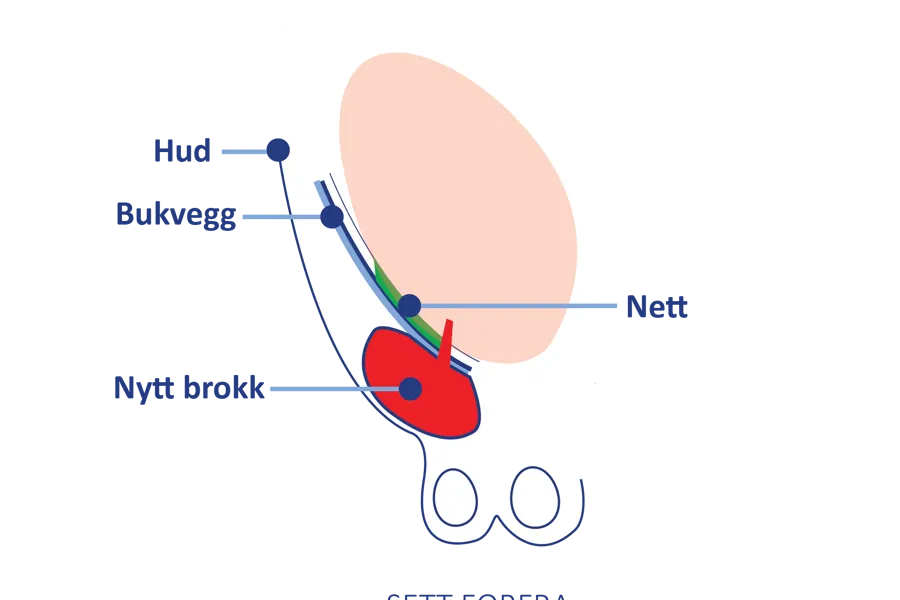 Anatomisk illustrasjon sett forfra som viser bukvegg, hud, nett og et nytt brokk som har oppstått ved lysken