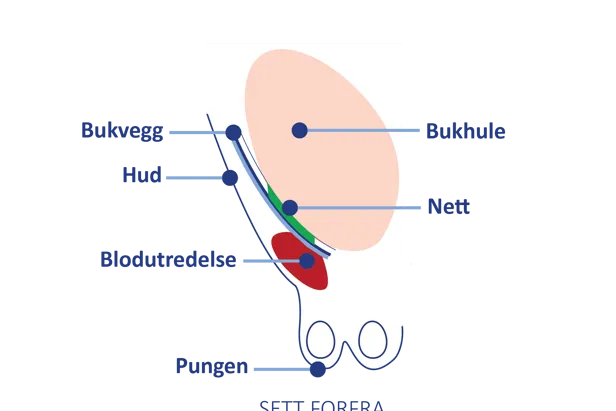 Anatomisk illustrasjon sett forfra som viser bukvegg, nett og en blodansamling (bloduttredelse) som kan oppstå etter operasjon.