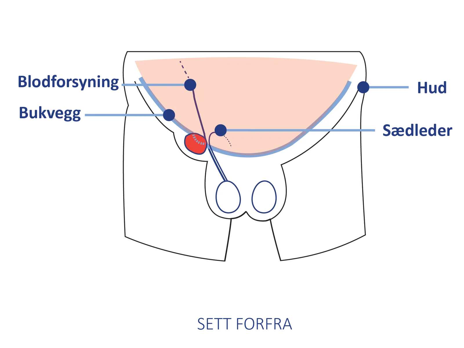 Anatomisk illustrasjon av lyskeområdet sett forfra, med markering av bukvegg, blodforsyning, sædleder og hud.
