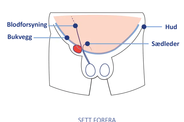 Anatomisk illustrasjon av lyskeområdet sett forfra, med markering av bukvegg, blodforsyning, sædleder og hud.