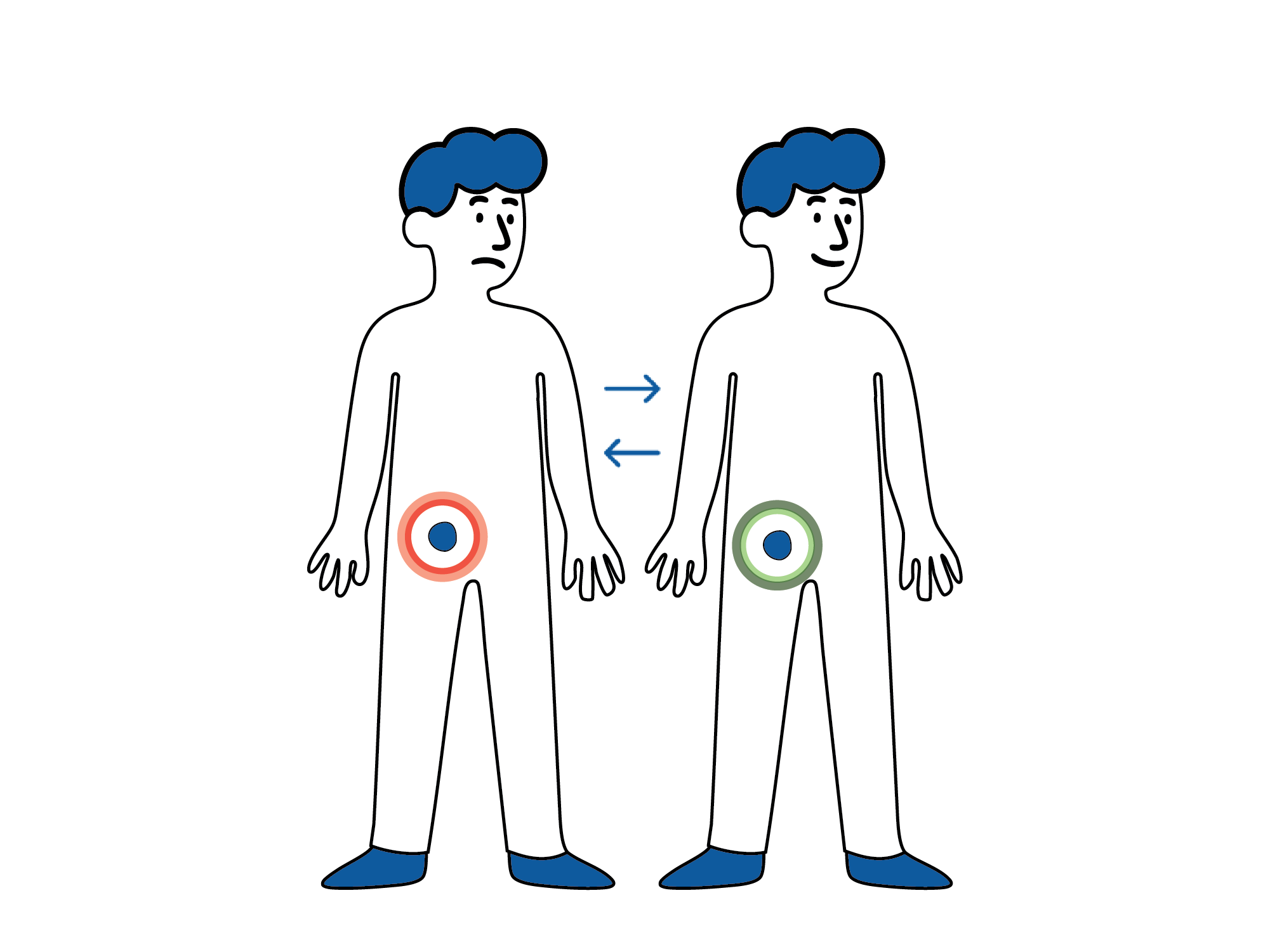 Medisinsk illustrasjon som viser at en lyskebrokk kan komme og gå, med vev som midlertidig buler ut i lysken.