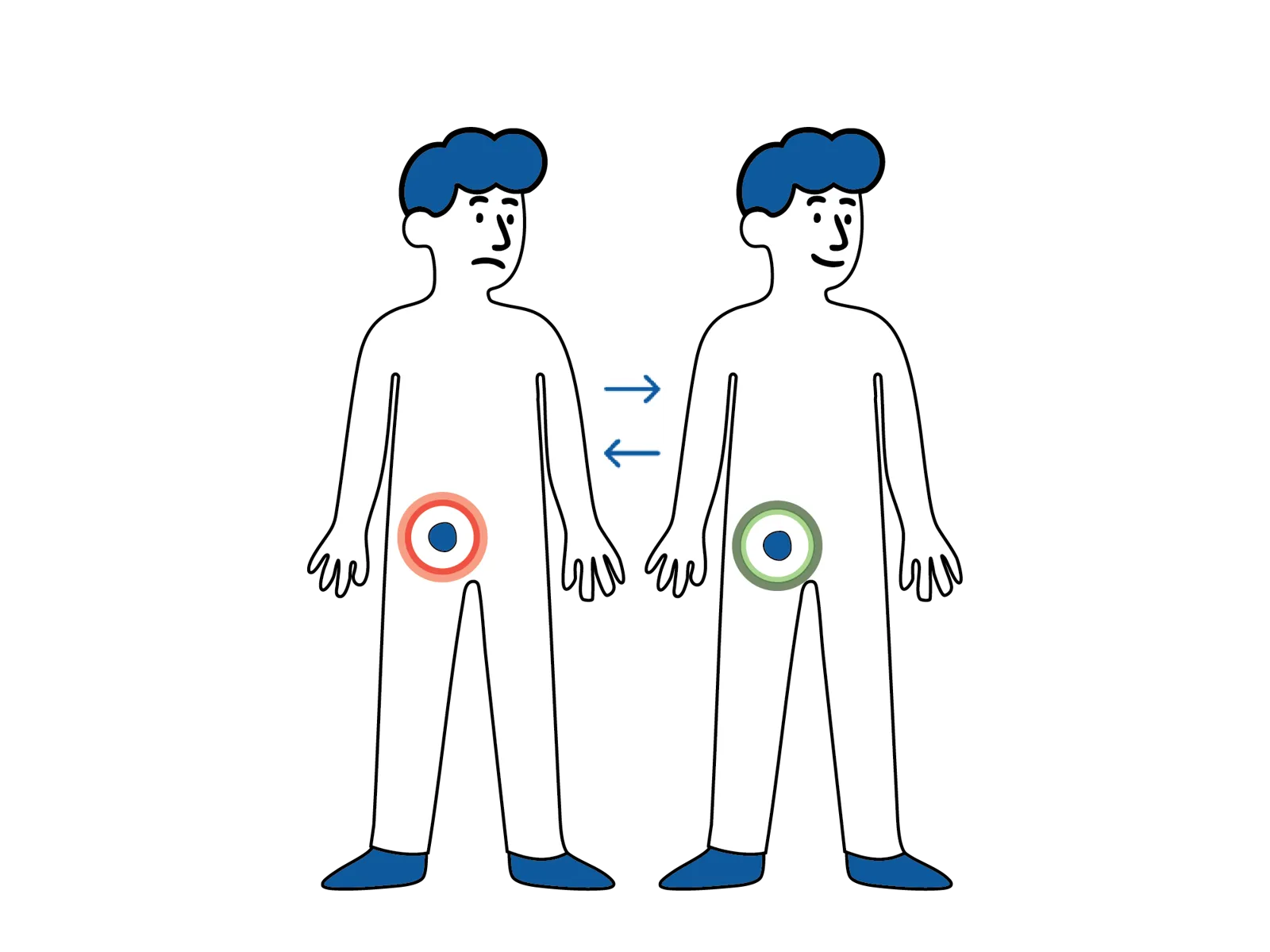 Medisinsk illustrasjon som viser at en lyskebrokk kan komme og gå, med vev som midlertidig buler ut i lysken.