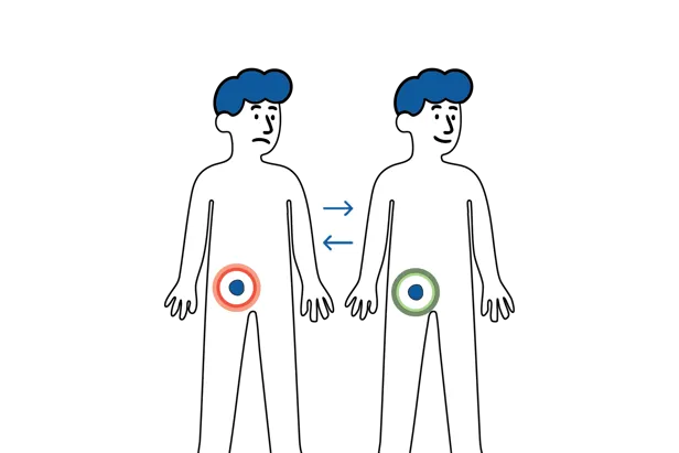 Medisinsk illustrasjon som viser at en lyskebrokk kan komme og gå, med vev som midlertidig buler ut i lysken.