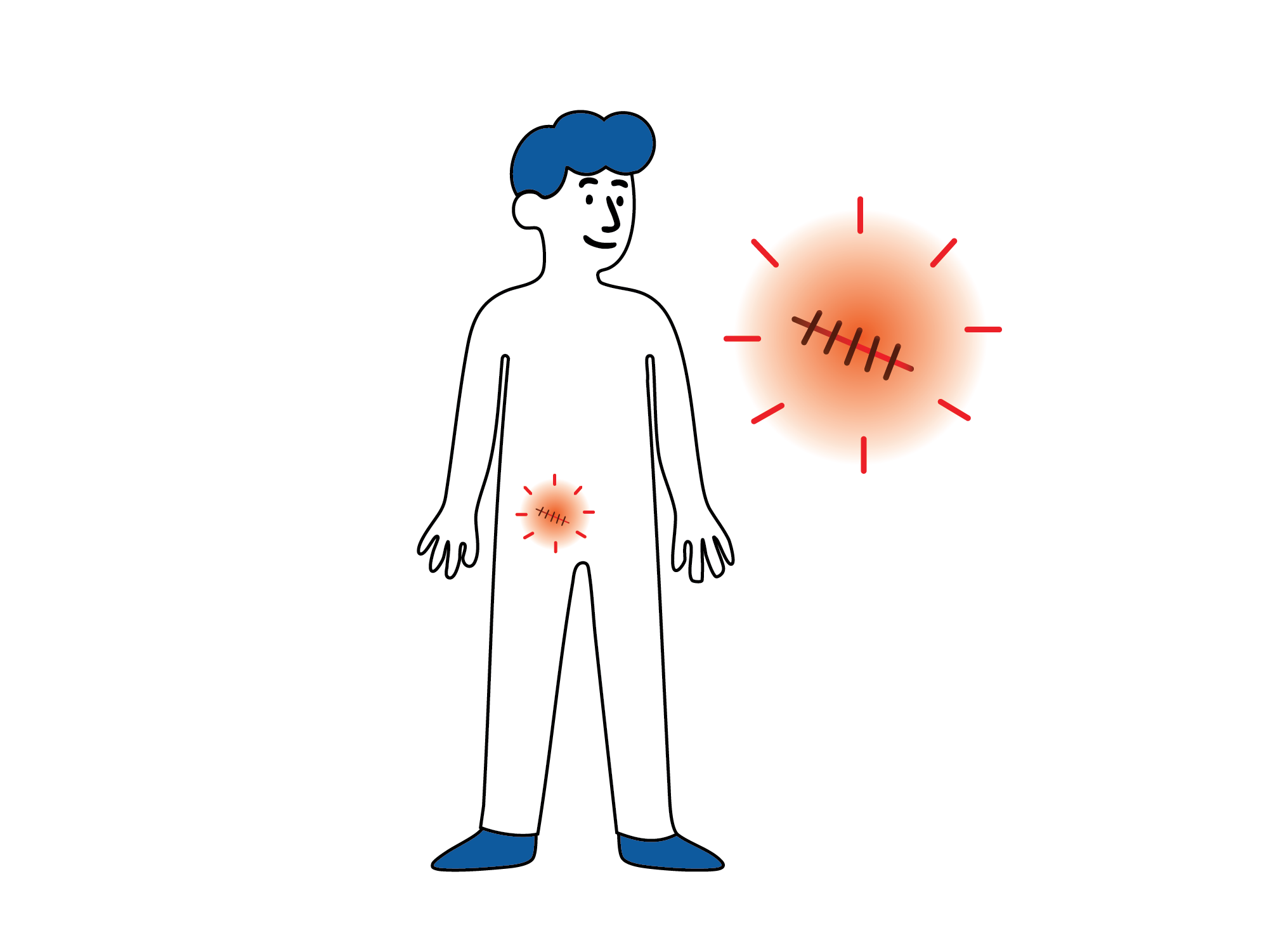 Illustrasjon av en person med rød og irritert hud rundt operasjonssåret, med et forstørret symbol som viser et betent sår med sting.