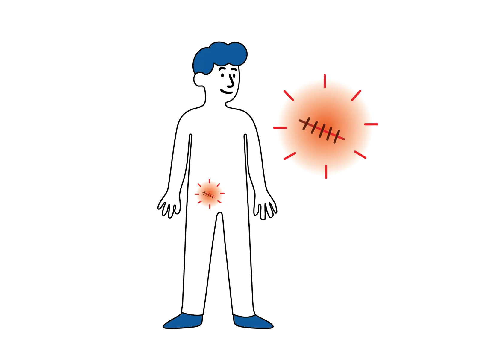 Illustrasjon av en person med rød og irritert hud rundt operasjonssåret, med et forstørret symbol som viser et betent sår med sting.