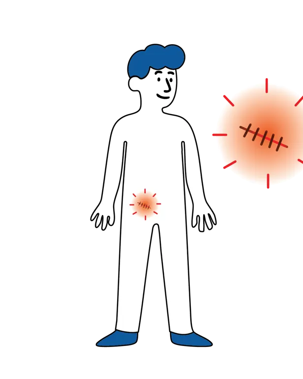 Illustrasjon av en person med rød og irritert hud rundt operasjonssåret, med et forstørret symbol som viser et betent sår med sting.