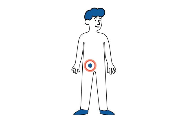 Illustrasjon som viser en kul i lysken på et menneske.