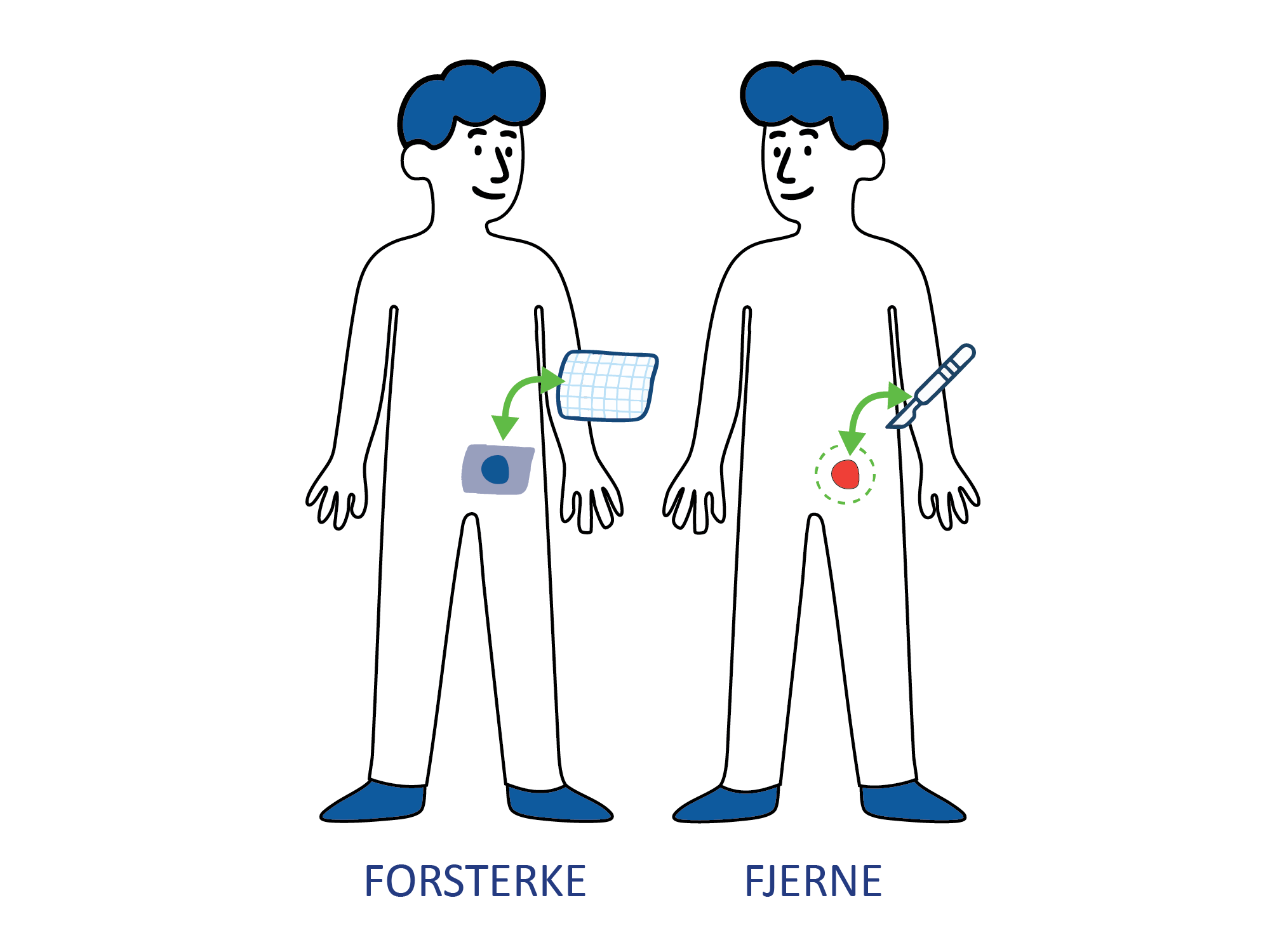 Medisinsk illustrasjon som viser to ulike operasjonsmetoder for behandling av lyskebrokk