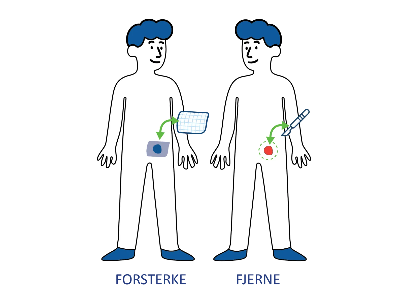 Medisinsk illustrasjon som viser to ulike operasjonsmetoder for behandling av lyskebrokk