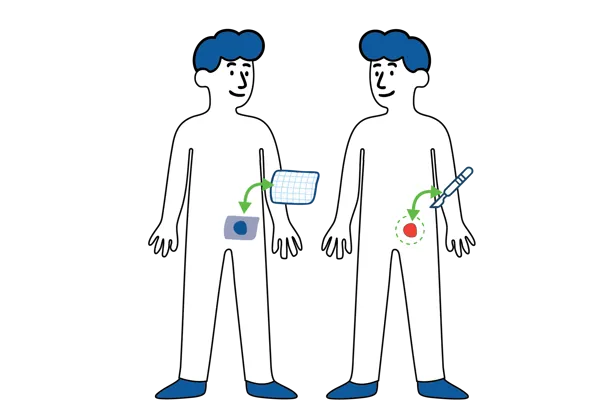 Medisinsk illustrasjon som viser to ulike operasjonsmetoder for behandling av lyskebrokk