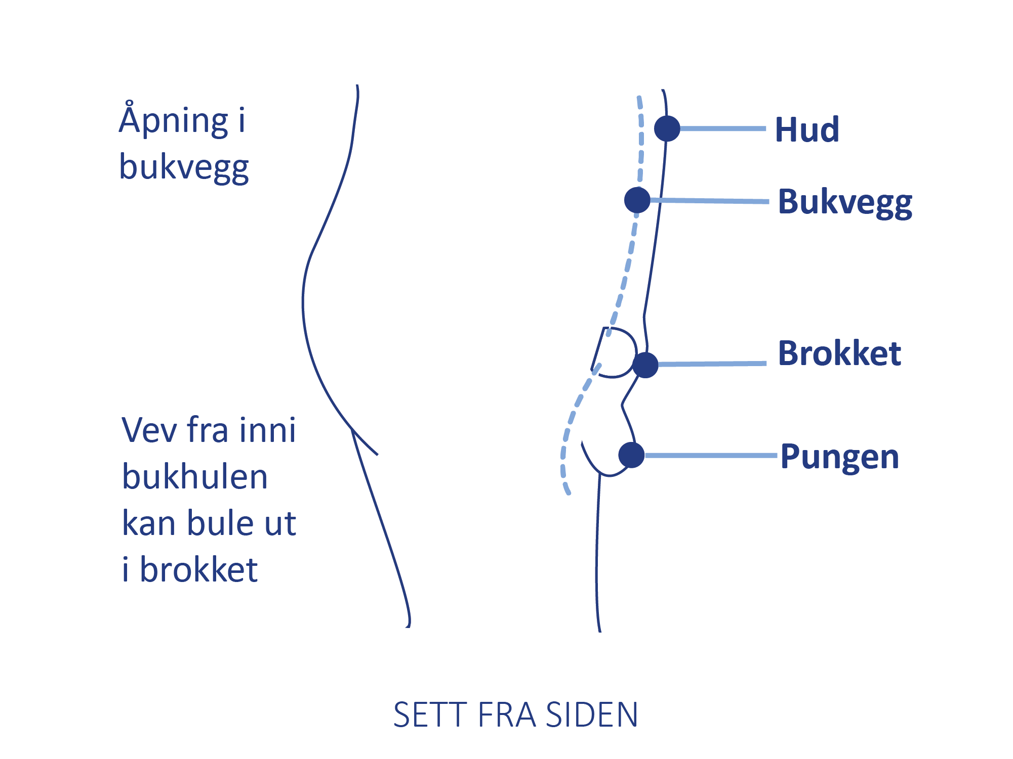 Medisinsk illustrasjon som viser vev fra bukhulen som presser seg ut gjennom et brokk