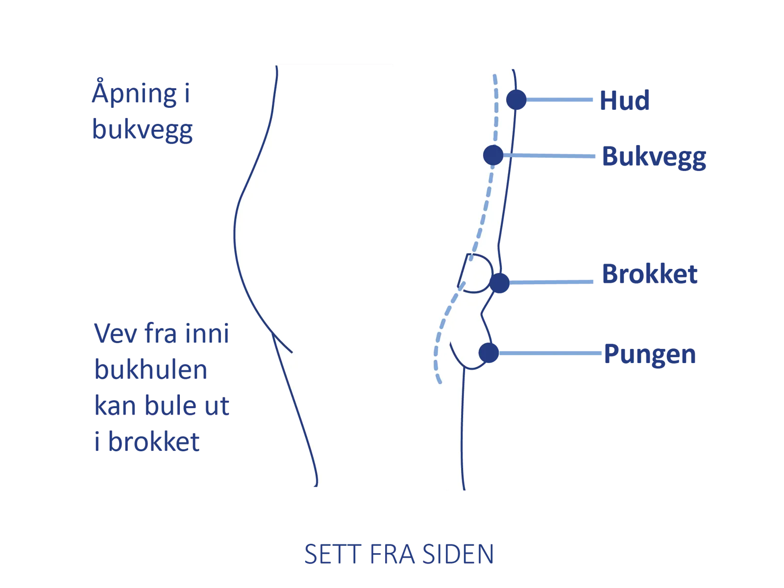 Medisinsk illustrasjon som viser vev fra bukhulen som presser seg ut gjennom et brokk
