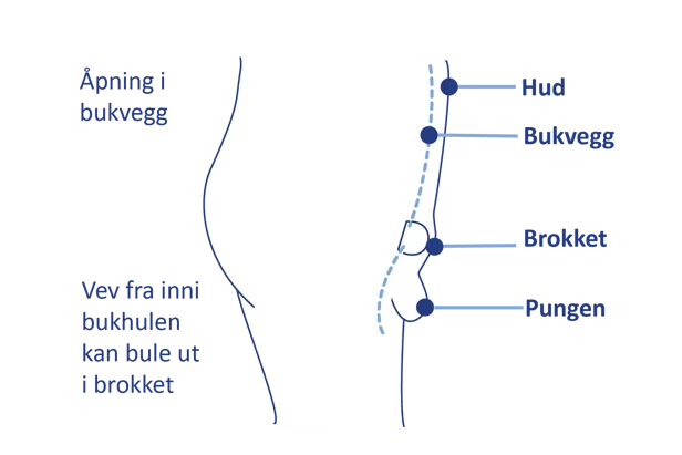Medisinsk illustrasjon som viser vev fra bukhulen som presser seg ut gjennom et brokk