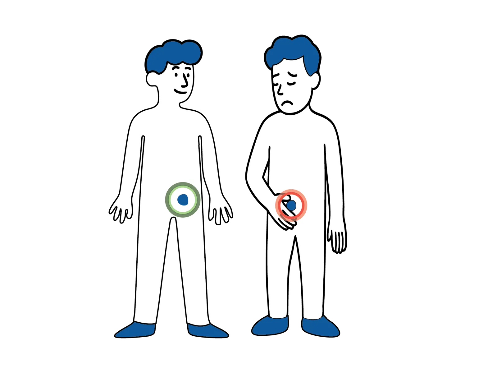 llustrasjon av to menneskefigurer som viser snittsteder ved kikkhulloperasjon (flere små snitt på magen) og åpen operasjon