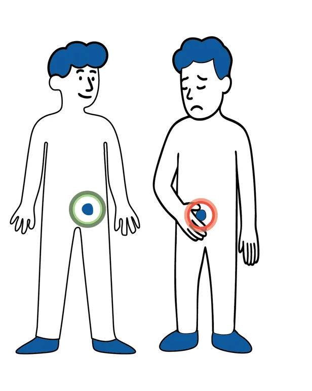 llustrasjon av to menneskefigurer som viser snittsteder ved kikkhulloperasjon (flere små snitt på magen) og åpen operasjon