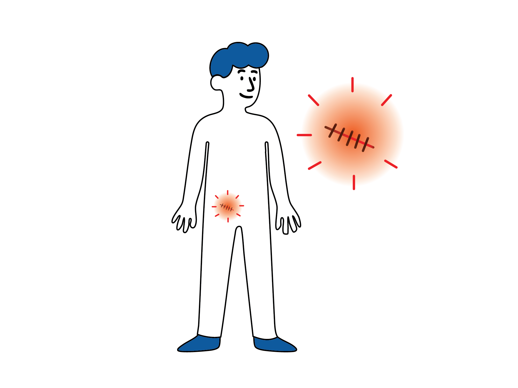 Illustrasjon av en person med markering over operasjonsområdet i lysken og et forstørret bilde av et rødt operasjonssår med sting