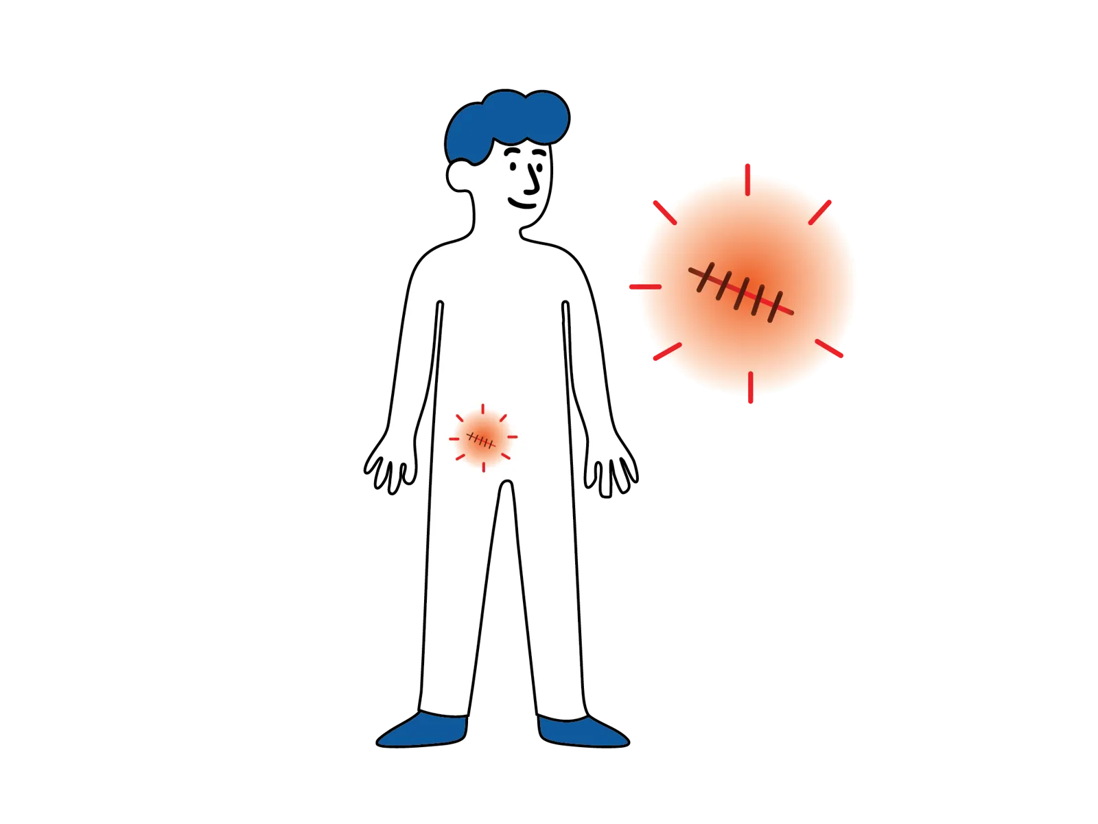Illustrasjon av en person med markering over operasjonsområdet i lysken og et forstørret bilde av et rødt operasjonssår med sting