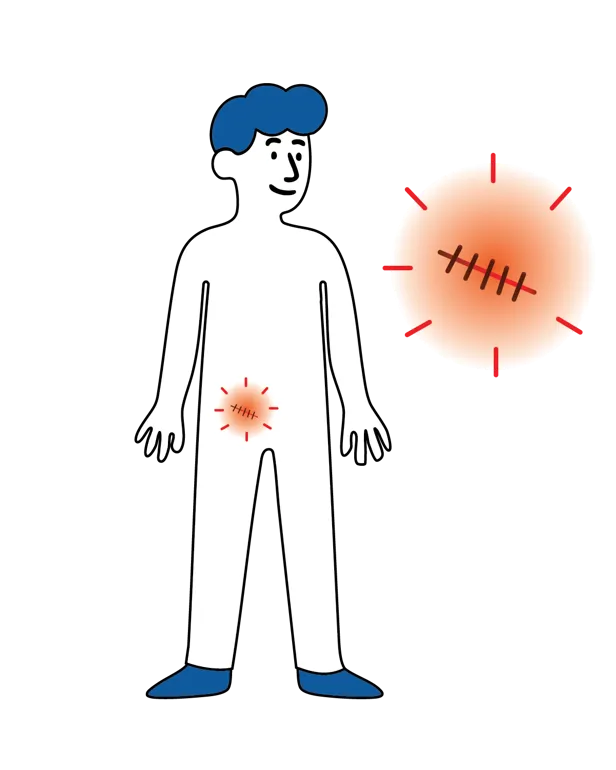 Illustrasjon av en person med markering over operasjonsområdet i lysken og et forstørret bilde av et rødt operasjonssår med sting