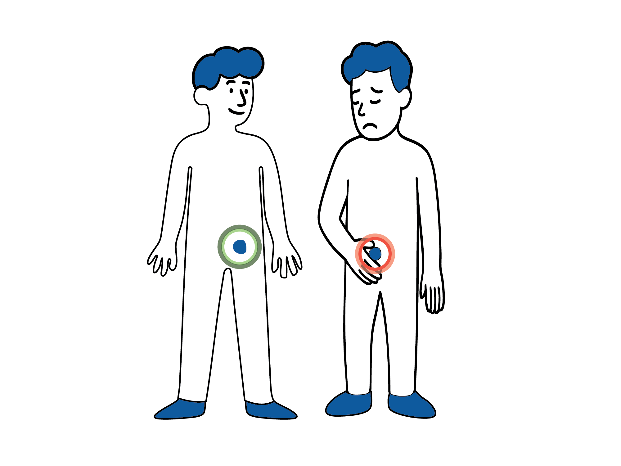 Illustrasjon av to personer, der den ene har normal grønn markering i lysken og den andre har rød markering og holder seg for området, som viser mulig komplikasjon.