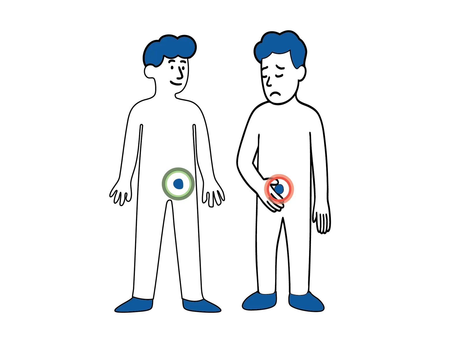 Illustrasjon av to personer, der den ene har normal grønn markering i lysken og den andre har rød markering og holder seg for området, som viser mulig komplikasjon.