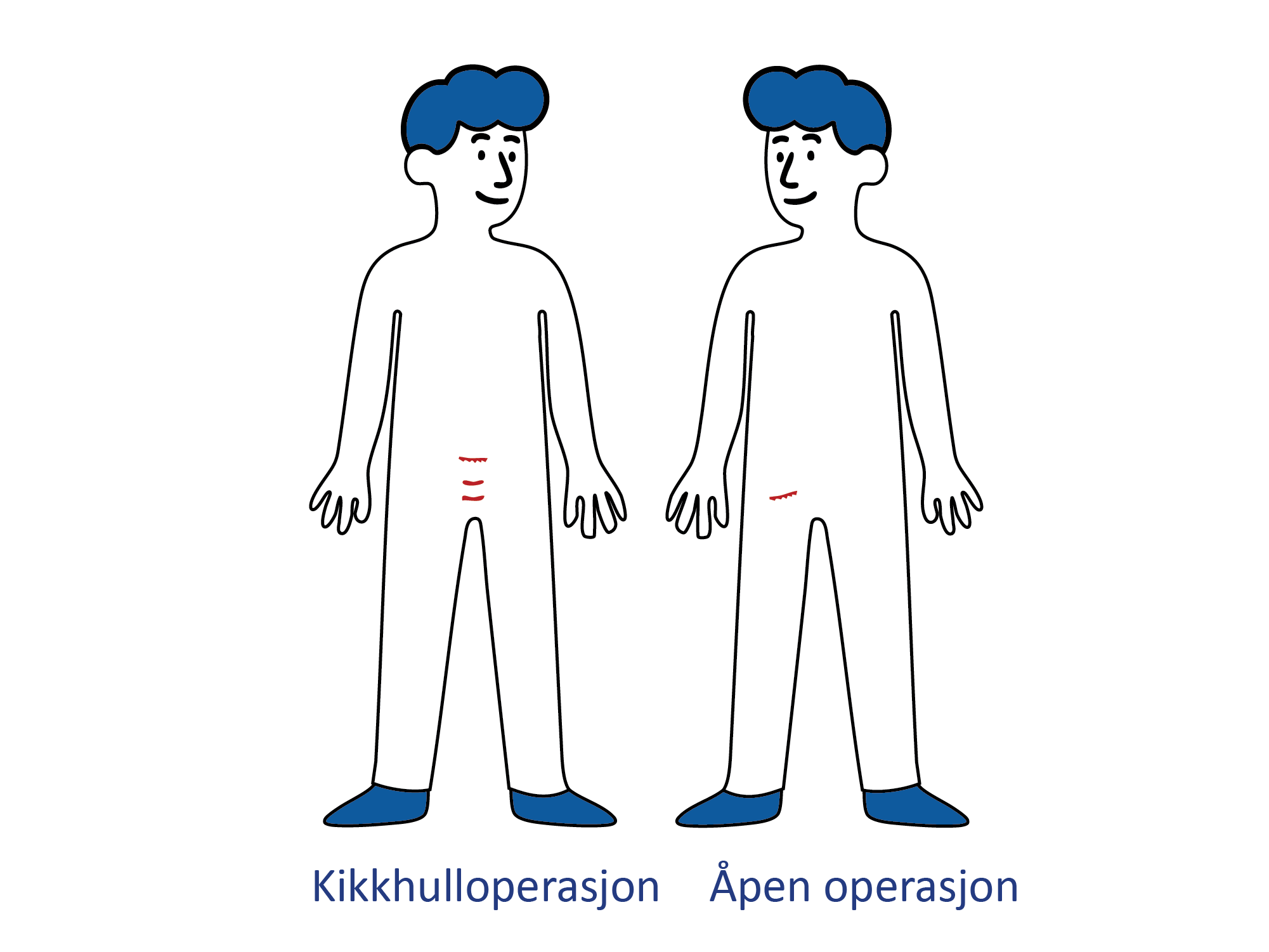 Illustrasjon av to menneskefigurer som viser snittsteder ved kikkhulloperasjon
