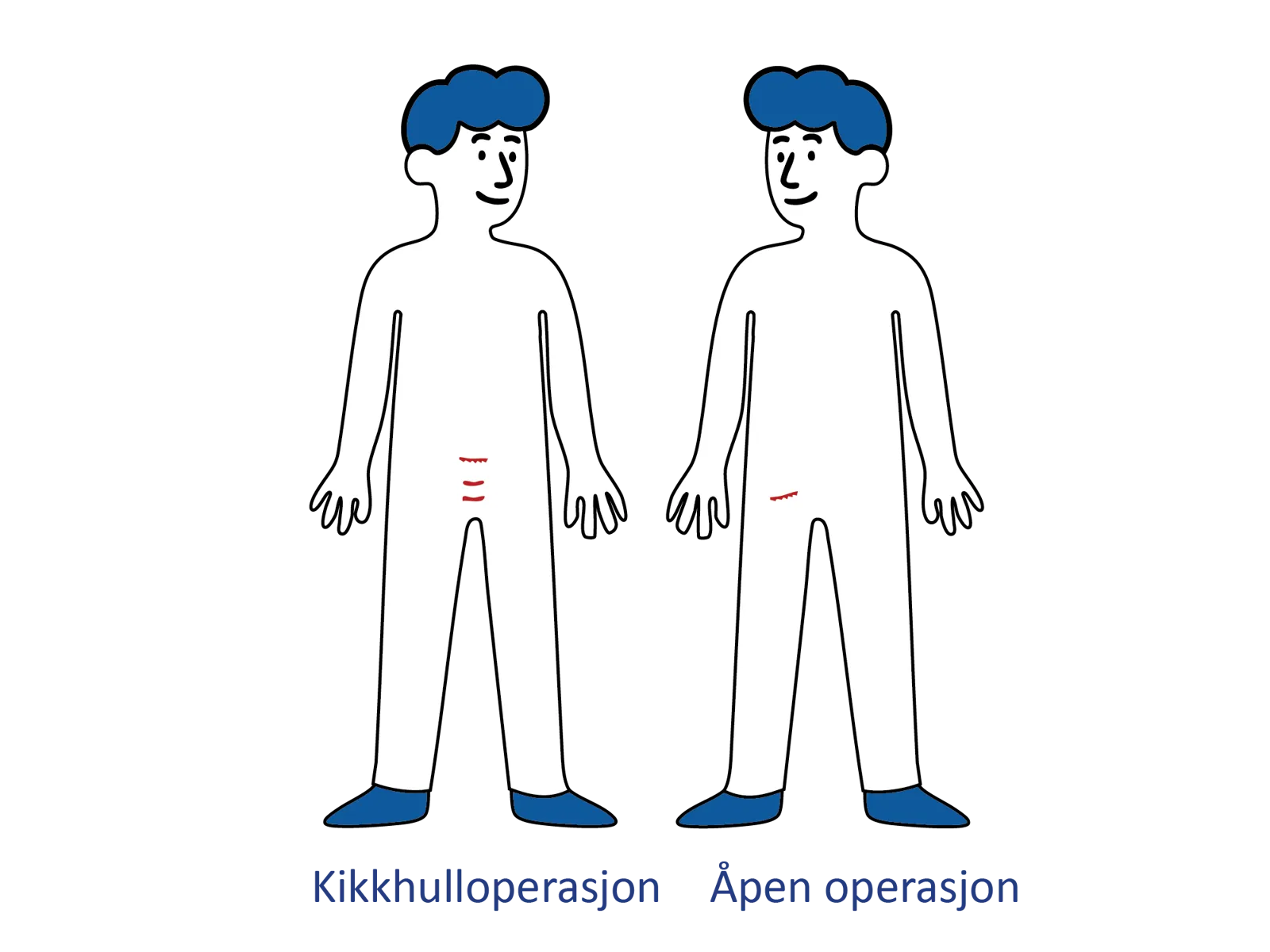 Illustrasjon av to menneskefigurer som viser snittsteder ved kikkhulloperasjon