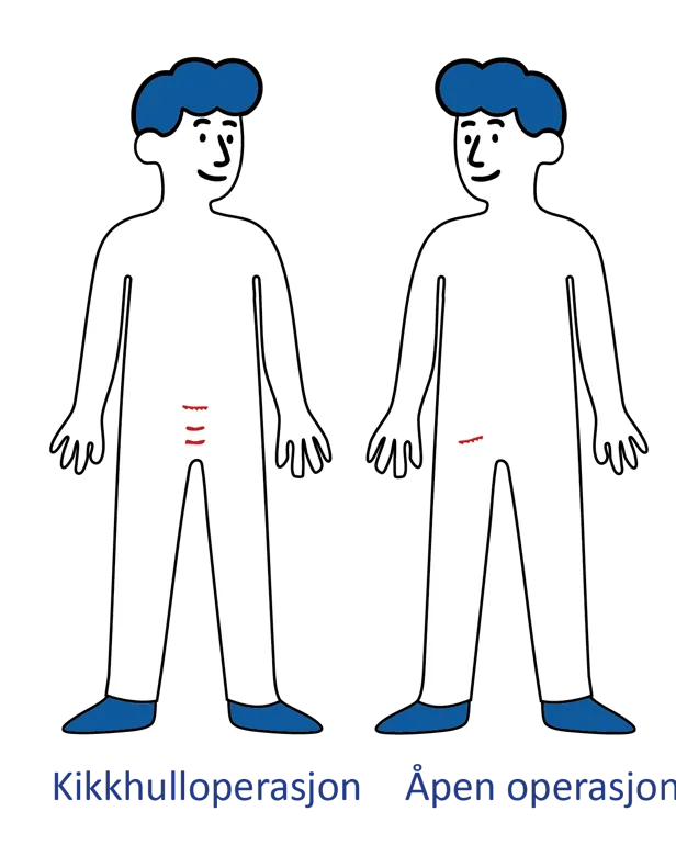 Illustrasjon av to menneskefigurer som viser snittsteder ved kikkhulloperasjon